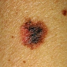 melanoma image